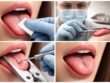 découvrez les étapes essentielles pour un piercing à la langue réussi et les précautions à prendre pour assurer une guérison optimale et éviter les complications.