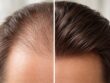 découvrez les effets de la crème diprosone sur la croissance des cheveux, ses bénéfices potentiels et précautions d'utilisation pour un cuir chevelu sain.