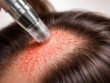 découvrez comment le microneedling pour les cheveux stimule la circulation sanguine du cuir chevelu, favorisant la pousse et la santé capillaire.